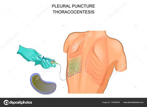 Thoracocentesis Pleural Puncture — Stock Vector © Artemida Psy 176383694