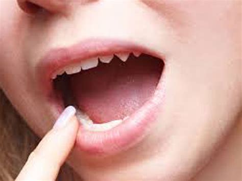 10 Home Remedies For Burning Tongue