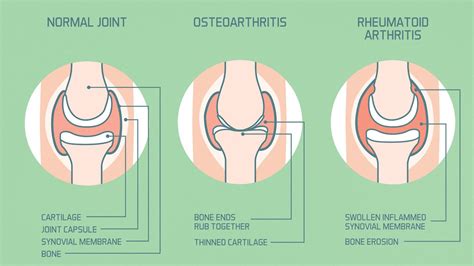 rheumatoid arthritis joint pain  osteoarthritis joint pain