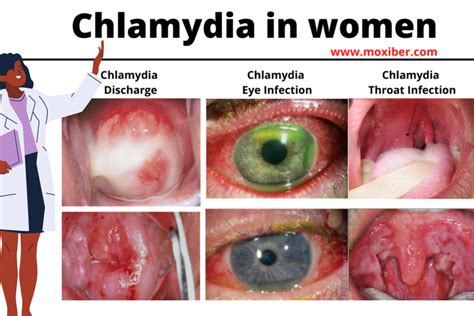 Chlamydia In Women Symptoms Health Nigeria