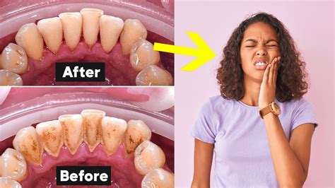 deep teeth cleaning recovery tips   heal fast youtube