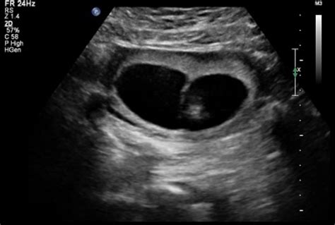 ultrasound embryology