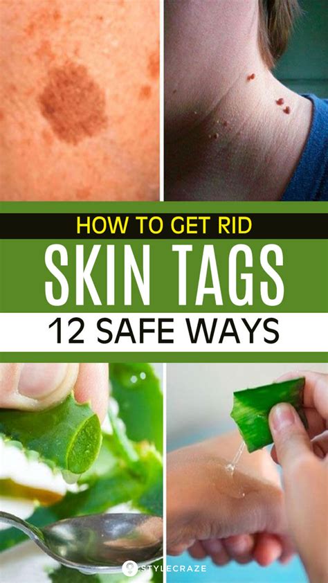 removing skin tags
