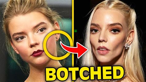 top  celebrities whove  botched  buccal fat removal youtube