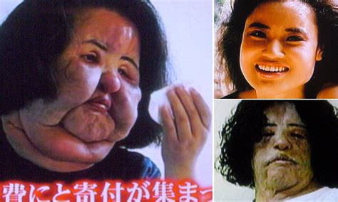 Korean Woman Hang Mioku Injects Cooking Oil Into Her Own Face After