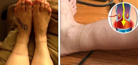 4 Health Problems That Sock Marks May Indicate The Cop Cart