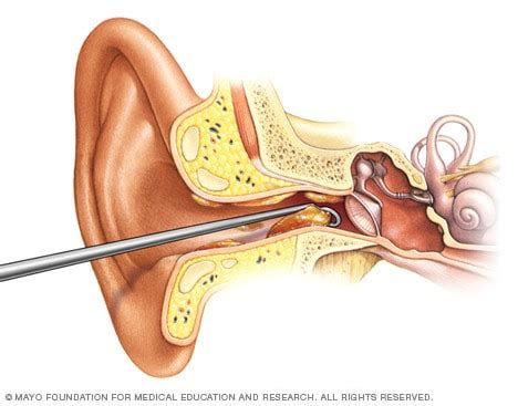 earwax removal   health care provider mayo clinic