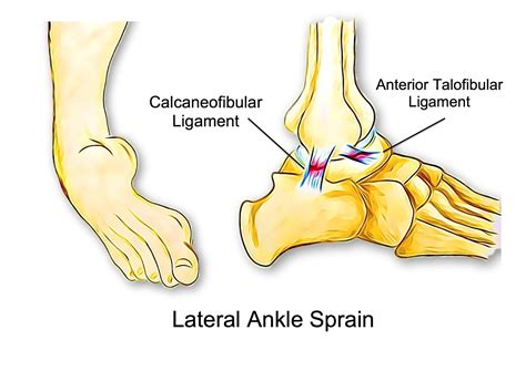 poor balance lead  ankle sprains beachbox physiotherapy