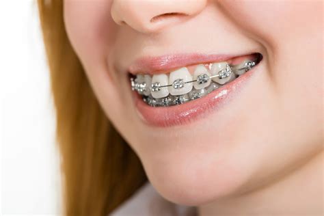 What Are The Different Types Of Teeth Braces Ateneodemonte Video