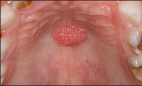 squamous papilloma  symptoms diagnosis treatment