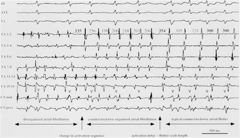 relationship between atrial fibrillation and typical atrial flutter in