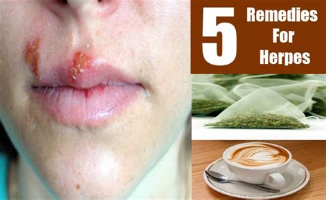 5 remedies for herpes natural treatments and cure for