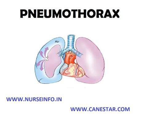 pneumothorax classification etiology risk factors