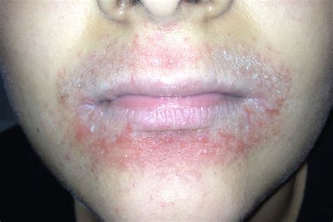 red rash  lips lipstutorialorg