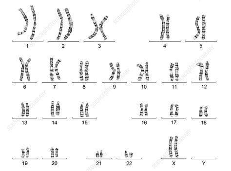Human Female Karyotype Stock Image C016 6742 Science Photo Library