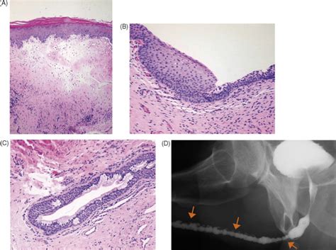 lichen sclerosus of the male genitalia and urethra surgical options