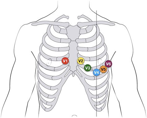 holter monitor  lead placement diagram wiring site resource