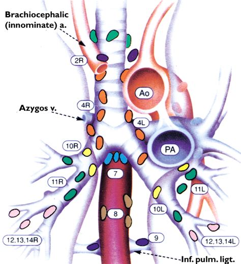 Ct Depiction Of Regional Nodal Stations For Lung Cancer Staging Ajr