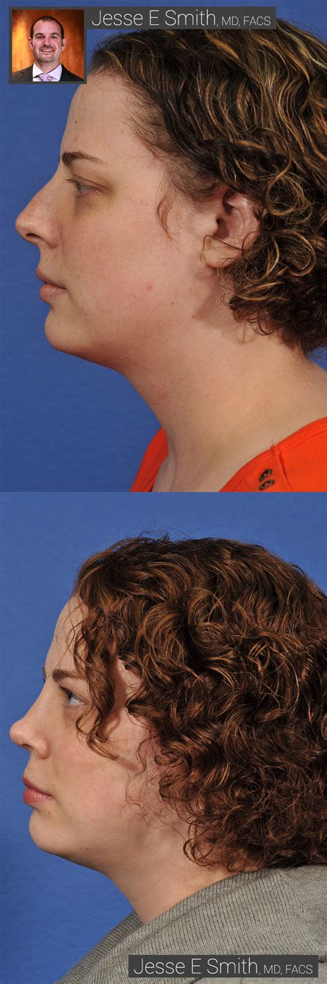 rhinoplasty before and after gallery jesse e smith md facs