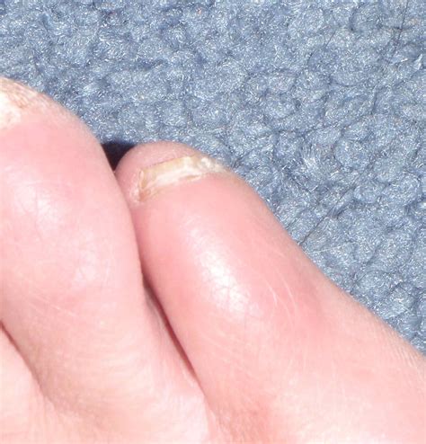 toe nail fungus barefoot running blood blisters  toe socks fun