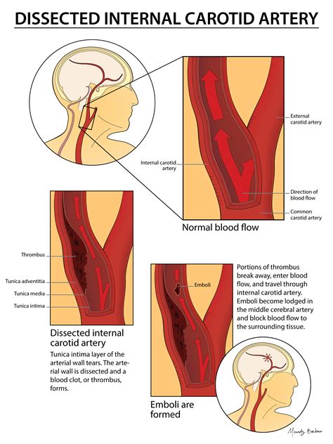 Carotid Artery Dissection Neck Pain And Horner’s Syndrome Pain Neck