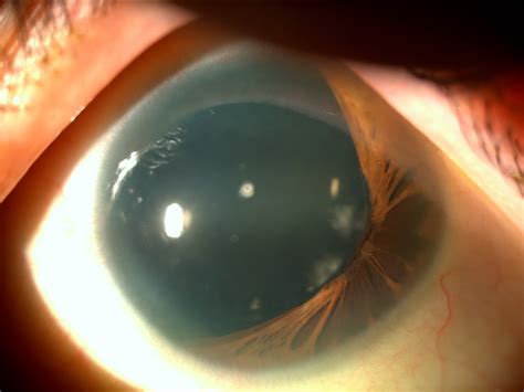 aniridia 1 hereditary ocular diseases