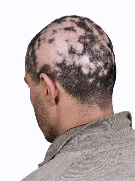 is your hair loss normal or a case of alopecia the pretty pimple