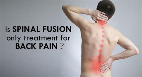 Spinal Fusion Surgery To Get Rid Of Backpain Ultimate Guide For Patients