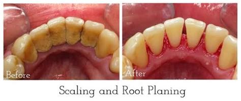 Is Scaling Of Teeth Harmful When It Is Done To Normal