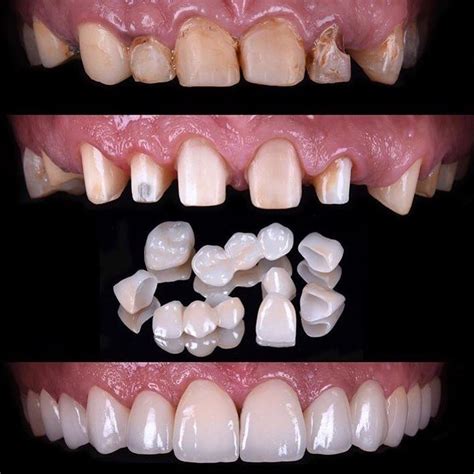 full mouth rehabilitation doshi dental care and facio maxillary centre
