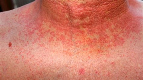 strep throat rash images the letter of recomendation