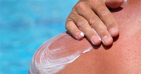 Pics These Cases Of Sunburn Are So Bad That You Can Almost Feel The