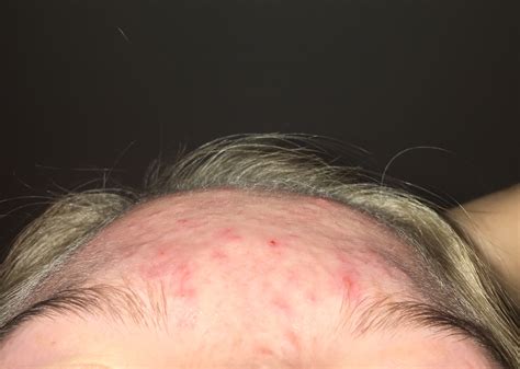 Forehead Acne Won T Heal General Acne Discussion Forum