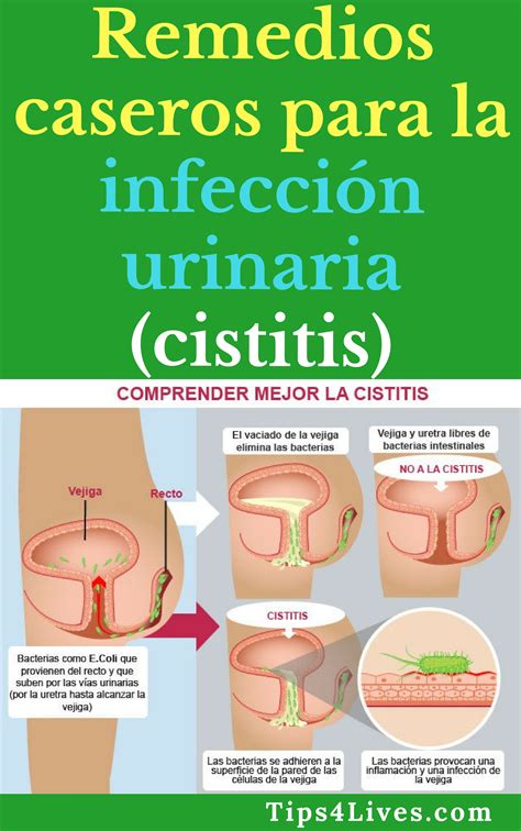 como tratar infeccion urinaria