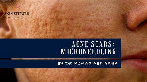 Acne Scars Microneedling Treatment Youtube