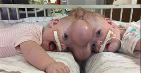 conjoined twins are finally going home after risky surgery