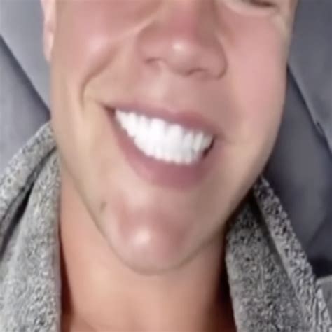 The Tiktok Veneers Trend Is Dangerous