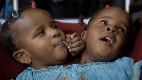 Bbc Two The Conjoined Twins An Impossible Decision Fighting For Life