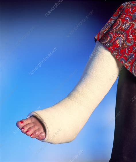 plaster cast   broken leg   woman stock image  science photo library