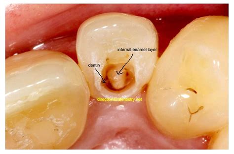 dens  dente maxillary lateral incisor clinical case