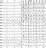 Epilepsy Eeg Seizure Issues sketch template