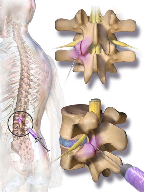 lumbar facet joint injections physiopedia