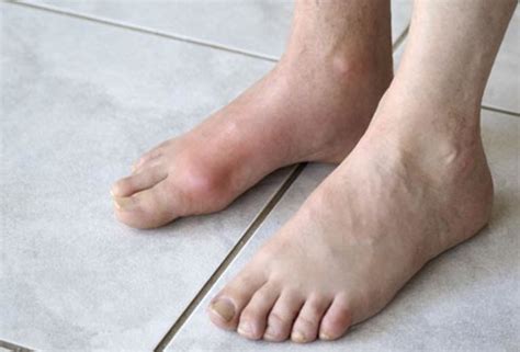 diabetes affects  feet  diabetic foot care hubpages