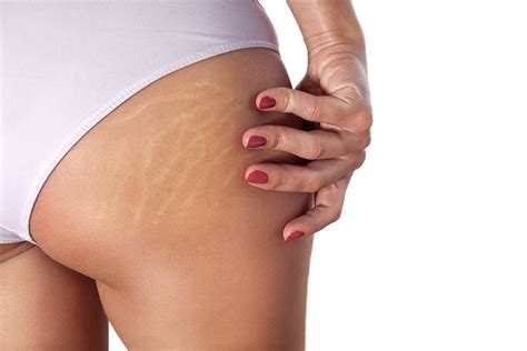 Inkless Stretch Mark Removal And Revision Isr Treatment