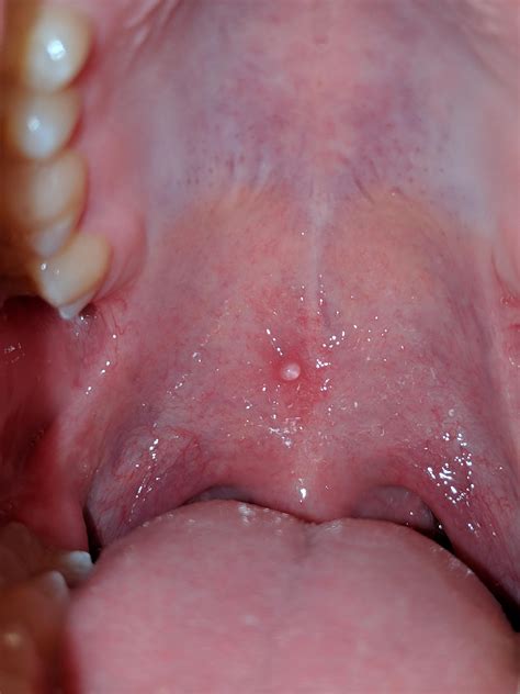 bumps    throat cancer