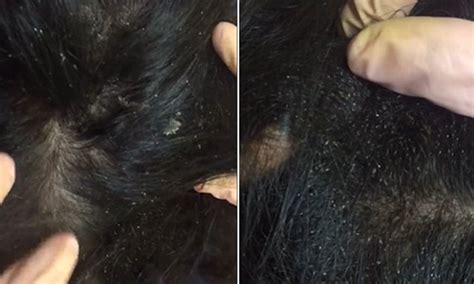 is this the worst case of head lice ever mother posts video of