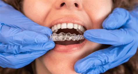 Invisalign Vs Braces Comparing Orthodontic Treatment Options Beach