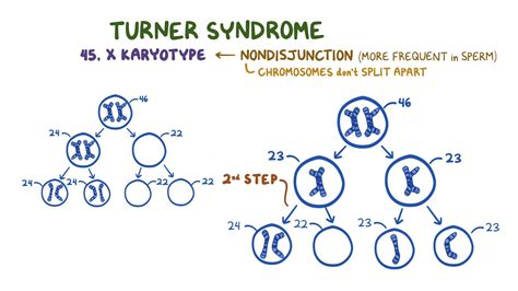 Turner Syndrome Year Of The Zebra Video And Anatomy Osmosis