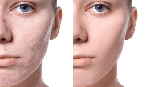 21 best acne scar treatments 2021 according to dermatologists allure