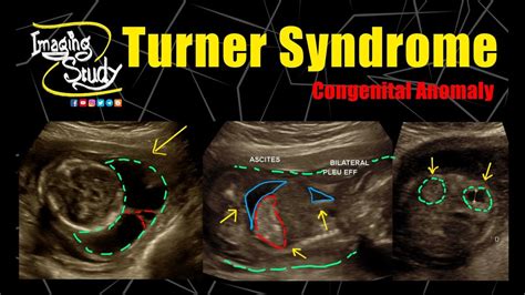 Turner Syndrome 45 X Monosomy X Ultrasound Anomaly Case